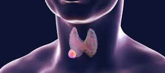 Thyroid Cancer